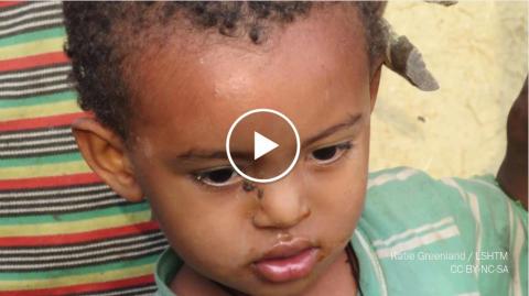 Cause And Symptoms Of Trachoma